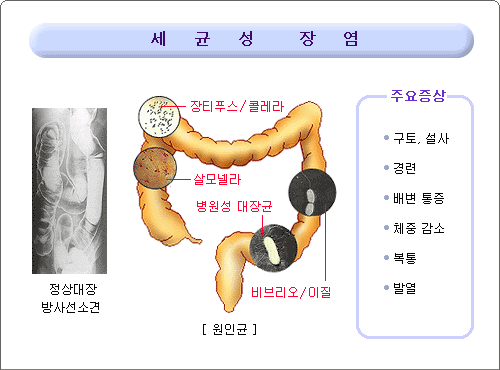 Creative Life... : (장염증상)장염에 좋은음식과 식이요법~!